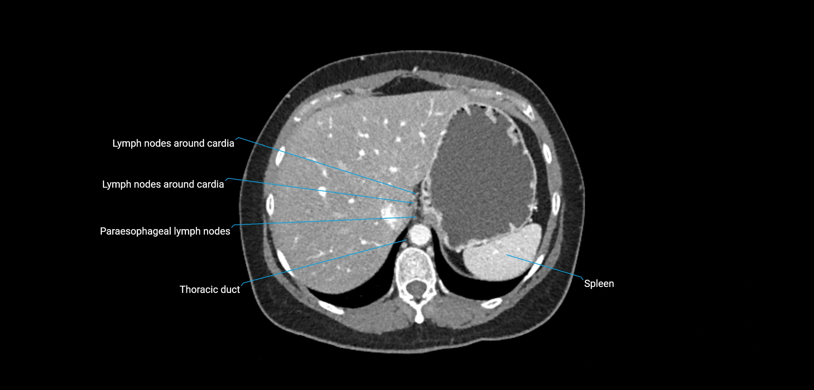 CT ct abdominal lymph nodes  axial cross sectional anatomy  enchanced radiology image -img-00002-00103.webp